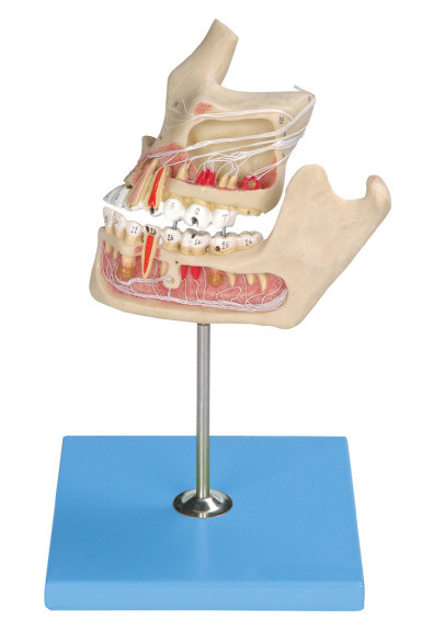 Modelo humano patológico de los dientes/modelo del mandíbula con de entonado de colores por el ordenador cerca de dos porciones