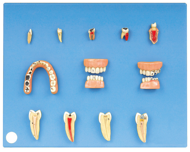 Modelo dental de las enfermedades hecho del PVC avanzado para la prácticas y el entrenamiento de los estudiantes