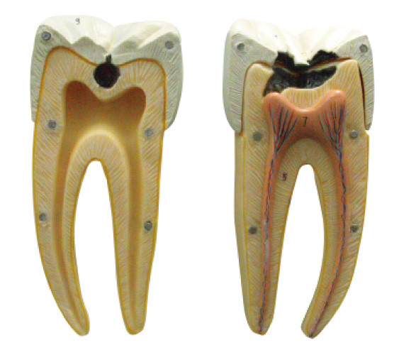 En inicial y etapas avanzadas del modelo de la carie dental para aprender y entrenar