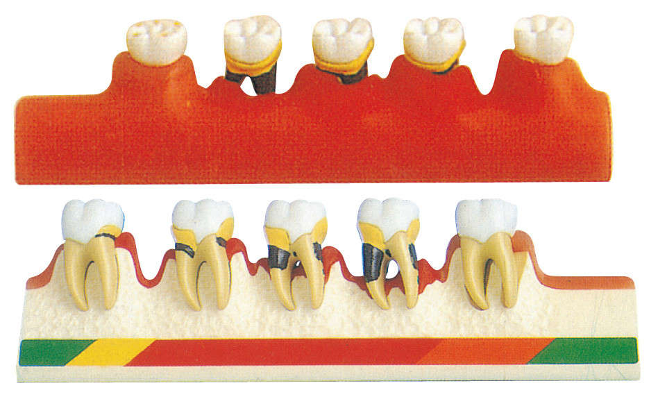 El modelo de la enfermedad periodontal incluye 5 porciones para el entrenamiento de las escuelas dentales