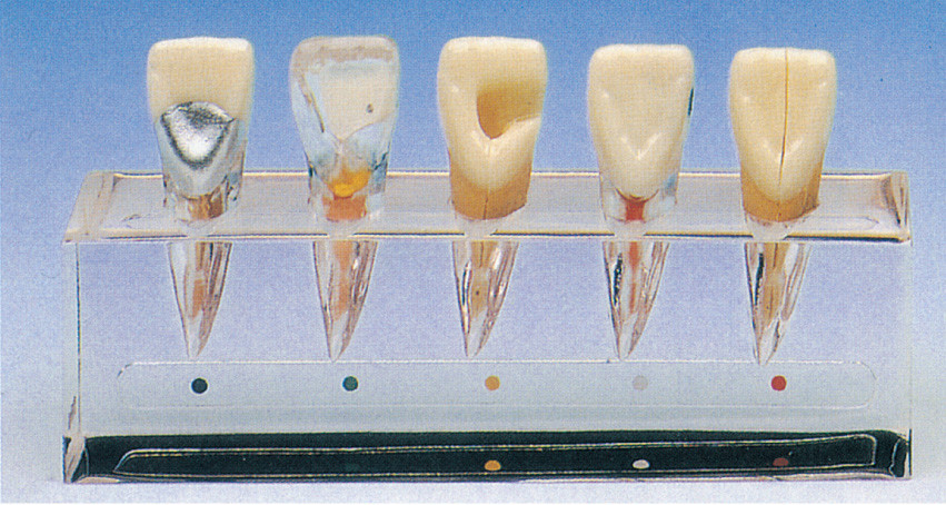 Modelo clínico de la serie de la enfermedad del diente cerca de 5 porciones para el entrenamiento de las escuelas dentales