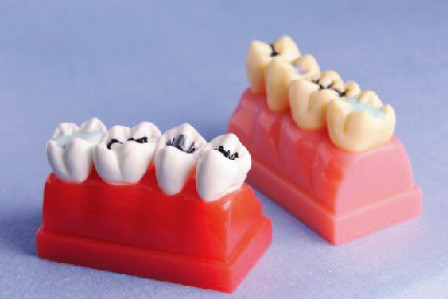 Modelo humano de los dientes para el modelo de la demostración del sellante y del embutido de 4 veces de tamaño natural