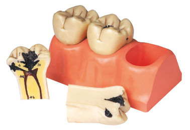 Modelo humano disecado de los dientes de la enfermedad dental para la prácticas y el entrenamiento de los estudiantes
